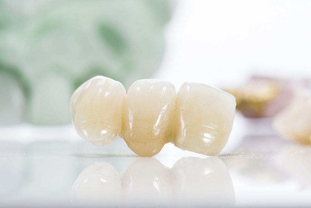 A blonde woman has dental crowns and bridges placed to help improve the health of her smile.